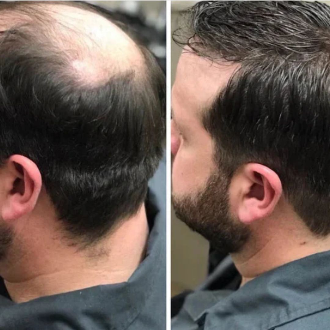 Anti-Hair™: Aceite regenerador anticaida